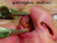 Image:nasal 1 wart.png