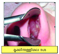 Image:nasal polyp.png