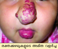 Image:nasal hemangioma.png