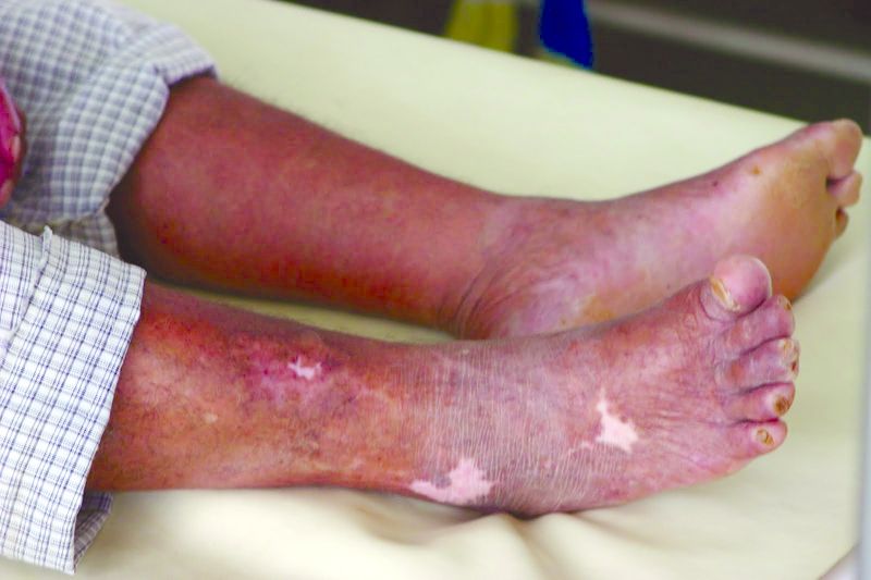 ചിത്രം:Vol7p798 Day 3-95 -- What Active Developing Leprosy Looks Like 2.jpg