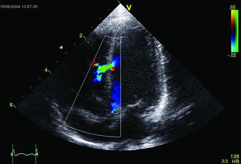 ചിത്രം:Vol5p17 An abnormal Echocardiogram. Image shows a mid-muscular ventricular septal defect.jpg