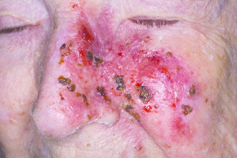 ചിത്രം:Vol5p729 Skin Cancer.jpg