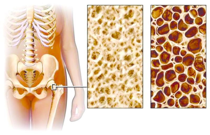 ചിത്രം:Vol5p825 Osteoporosis-wallpaper.jpg